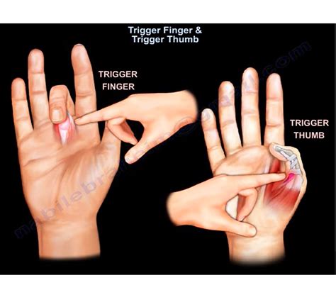 Left middle finger trigger finger icd 10. Things To Know About Left middle finger trigger finger icd 10. 